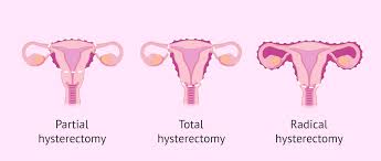 Hysterectomy Specialist in Wakad, Pune